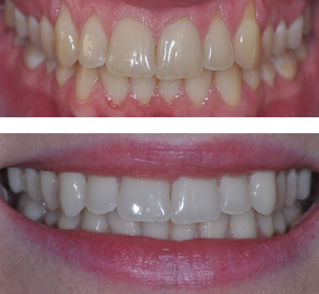 Blanchiment Des Dents : les différentes méthodes